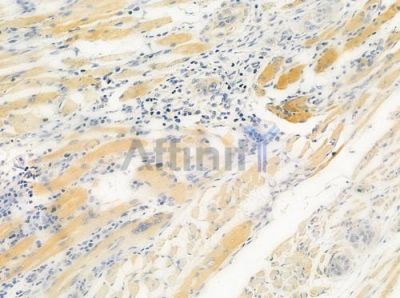 CHI3L1 Antibody - DF6577 at 1/100 staining human tongue carcinoma by IHC-P.