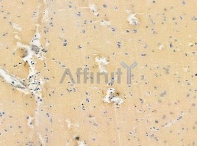 CHI3L1 Antibody - DF6577 at 1/100 staining human glioblastoma by IHC-P.