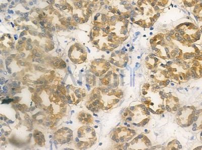 MOK Antibody - DF6618 at 1/100 staining human renal cell carcinoma by IHC-P.