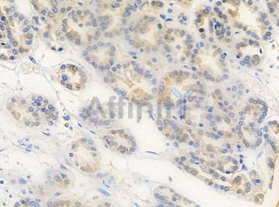 DDB2 Antibody - DF6658 at 1/100 staining human renal cell carcinoma by IHC-P.