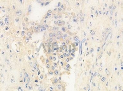 LY96 Antibody - DF6669 at 1/100 staining human prostate carcinoma by IHC-P.