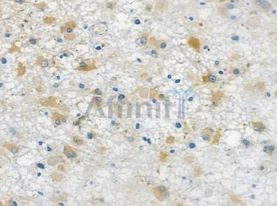 CD27 Antibody - DF6709 at 1/100 staining human astrocytoma by IHC-P.