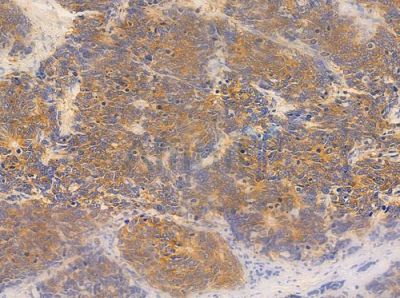 ANGPTL4 Antibody - DF6751 at 1/100 staining human small cell lung carcinoma by IHC-P.