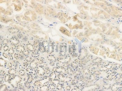 CCNT1 Antibody - DF6787 at 1/100 staining human renal cell carcinoma by IHC-P.
