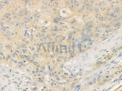 MKK7 Antibody - DF6909 at 1/100 staining human tongue carcinoma by IHC-P.