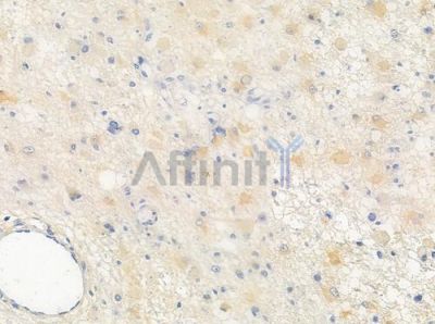 PATE3 Antibody - DF6927 at 1/100 staining human astrocytoma by IHC-P.