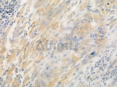 CEACAM3 Antibody - DF7039 at 1/100 staining human tongue carcinoma by IHC-P.