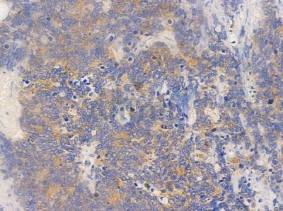 Gelsolin Antibody - DF7117 at 1/100 staining human small cell lung carcinoma by IHC-P.
