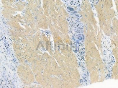 LCN2 Antibody - DF7232 at 1/100 staining human gastric carcinoma by IHC-P.