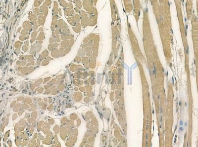 TUBA4A  Antibody - DF7240 at 1/100 staining human tongue carcinoma by IHC-P.