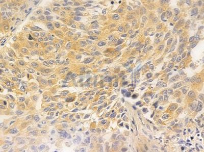 EIF4A1 Antibody - DF7256 at 1/100 staining human lung squamous cell carcinoma by IHC-P.