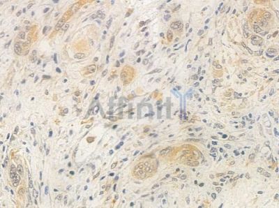 EIF4A1 Antibody - DF7256 at 1/100 staining human tongue carcinoma by IHC-P.