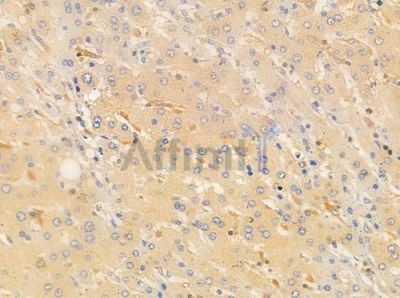 ATL1 Antibody - DF7262 at 1/100 staining human hepatocellular carcinoma by IHC-P.
