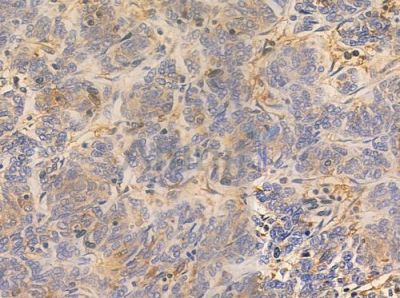 ATL1 Antibody - DF7262 at 1/100 staining human thymoma by IHC-P.