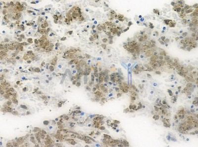HUS1 Antibody - DF7326 at 1/100 staining human melanoma by IHC-P.