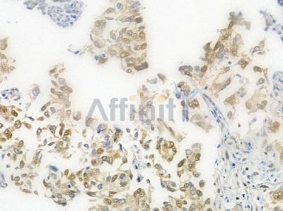 HUS1 Antibody - DF7326 at 1/100 staining human lung squamous cell carcinoma by IHC-P.