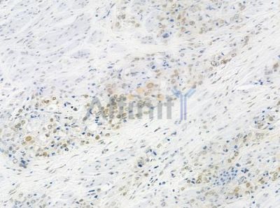 HUS1 Antibody - DF7326 at 1/100 staining human prostate carcinoma by IHC-P.
