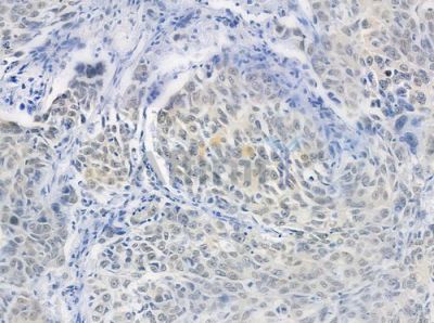 HUS1 Antibody - DF7326 at 1/100 staining human lung squamous cell carcinoma by IHC-P.