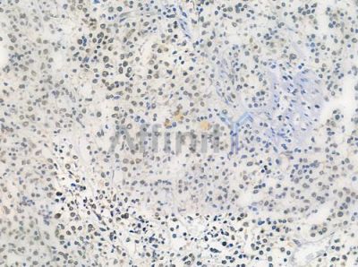 HUS1 Antibody - DF7326 at 1/100 staining human Hodgkin lymphoma by IHC-P.