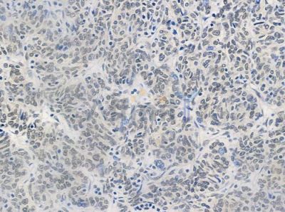 HUS1 Antibody - DF7326 at 1/100 staining human thymoma by IHC-P.