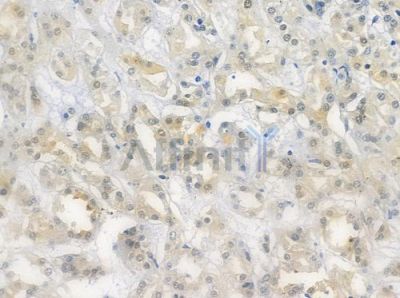 HUS1 Antibody - DF7326 at 1/100 staining human renal cell carcinoma by IHC-P.