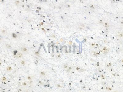 HUS1 Antibody - DF7326 at 1/100 staining human astrocytoma by IHC-P.