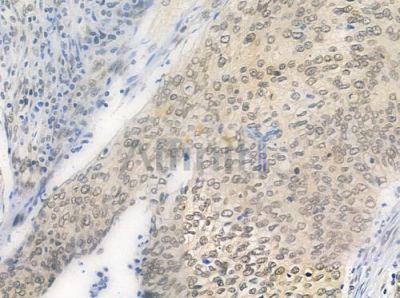 HUS1 Antibody - DF7326 at 1/100 staining human cervical carcinoma by IHC-P.