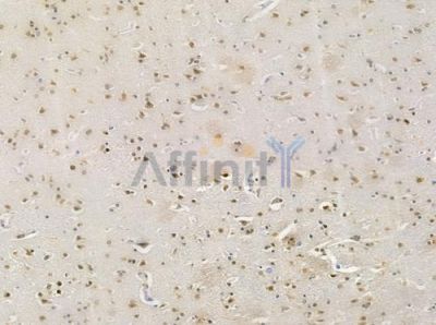 HUS1 Antibody - DF7326 at 1/100 staining human glioblastoma by IHC-P.