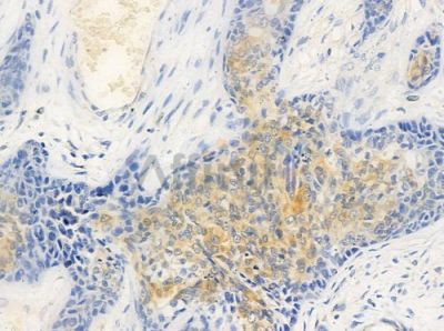 NDUFA13 Antibody - DF7330 at 1/100 staining human breast carcinoma by IHC-P.