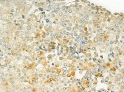 WHSC1L1 Antibody - DF7410 at 1/100 staining human prostate carcinoma by IHC-P.
