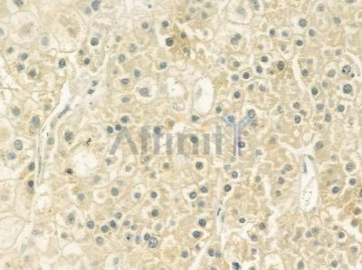 Hemopexin Antibody - DF7415 at 1/100 staining human hepatocellular carcinoma by IHC-P.