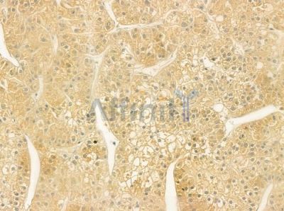 Hemopexin Antibody - DF7415 at 1/100 staining human hepatocellular carcinoma by IHC-P.