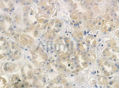 RAB6A Antibody - DF7417 at 1/100 staining human renal cell carcinoma by IHC-P.