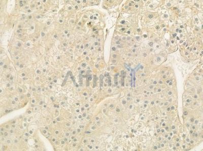 TPP1 Antibody - DF7425 at 1/100 staining human hepatocellular carcinoma by IHC-P.