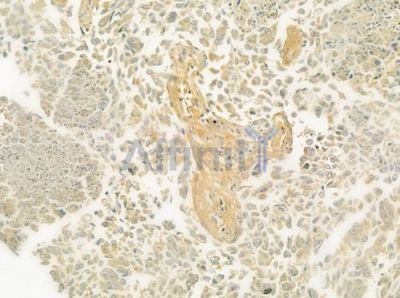ECE1 Antibody - DF7430 at 1/100 staining human lung squamous cell carcinoma by IHC-P.