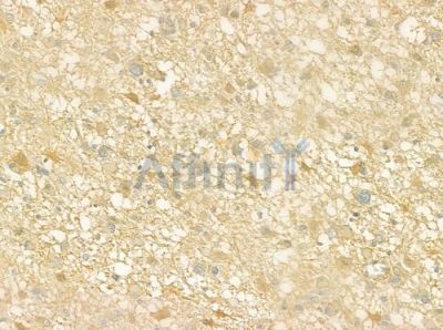ECE1 Antibody - DF7430 at 1/100 staining human astrocytoma by IHC-P.