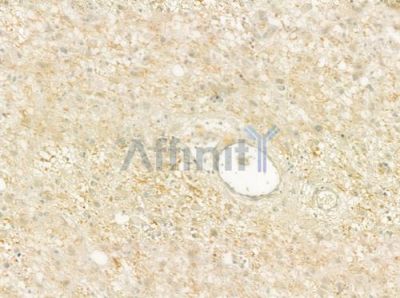 ATP7B Antibody - DF7454 at 1/100 staining human astrocytoma by IHC-P.