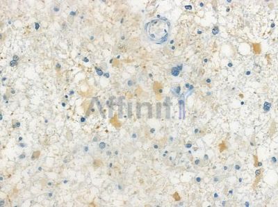 p62Dok Antibody - DF7459 at 1/100 staining human astrocytoma by IHC-P.