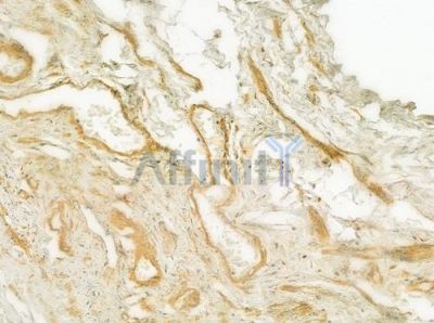 CLCN5 Antibody - DF7469 at 1/100 staining human small cell lung carcinoma by IHC-P.