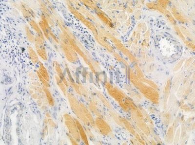 Sin1 Antibody - DF7526 at 1/100 staining human tongue carcinoma by IHC-P.