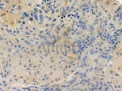 USP22 Antibody - DF7591 at 1/100 staining human lung squamous cell carcinoma by IHC-P.