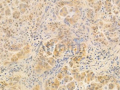 Prohibitin Antibody - DF7600 at 1/100 staining human lung adenocarcinoma by IHC-P.