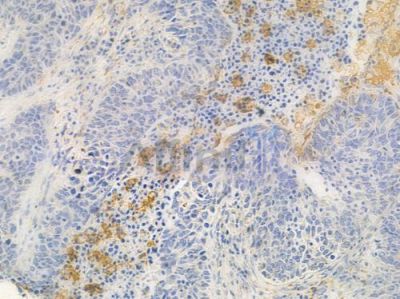 ADFP Antibody - DF7603 at 1/100 staining human large cell lung carcinoma by IHC-P.