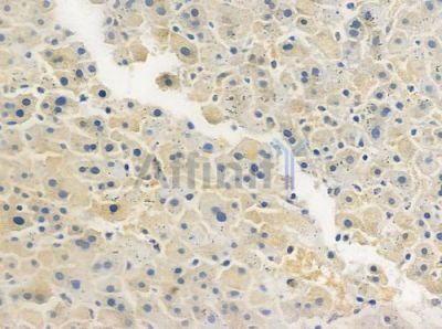 CARD11 Antibody - DF7613 at 1/100 staining human hepatocellular carcinoma by IHC-P.