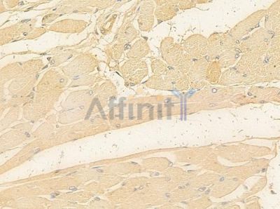 PIK3CD Antibody - DF7618 at 1/100 staining human tongue carcinoma by IHC-P.