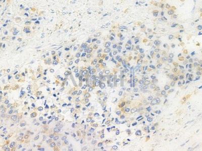 CD40L Antibody - DF7678 at 1/100 staining human prostate carcinoma by IHC-P.