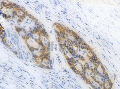 Sall4 Antibody - DF7757 at 1/100 staining human pancreatic carcinoma by IHC-P.