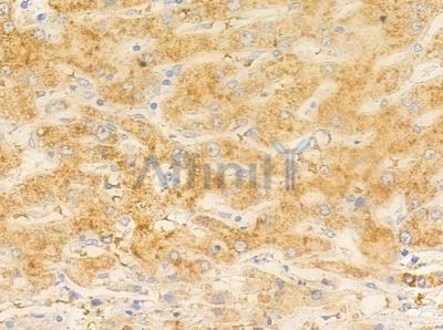SPTAN1 Antibody - DF7847 at 1/100 staining human hepatocellular carcinoma by IHC-P.