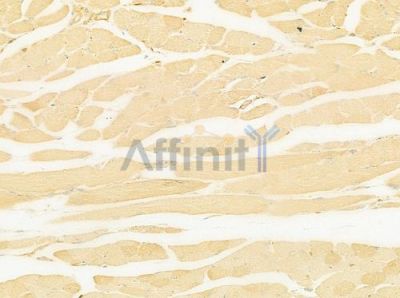 F13A1 Antibody - DF7861 at 1/100 staining human tongue carcinoma by IHC-P.