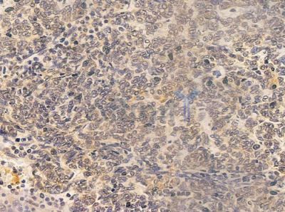FLII Antibody - DF8003 at 1/100 staining human thymoma by IHC-P.